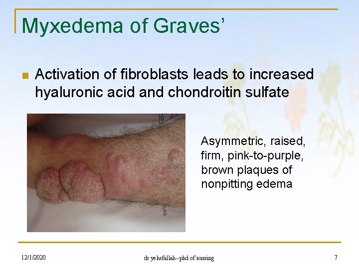 Myxedema of Graves’ n Activation of fibroblasts leads to increased hyaluronic acid and chondroitin