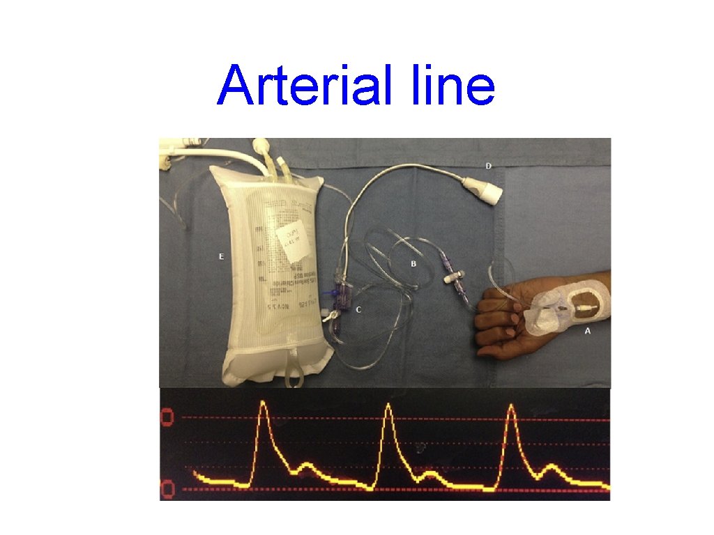 Arterial line 