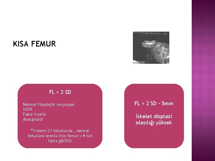 KISA FEMUR FL < 2 SD Normal fizyolojik varyasyon IUGR Fokal kısalık Aneuploidi *Trizomi