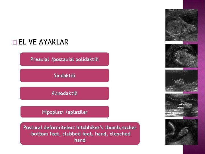 � EL VE AYAKLAR Preaxial /postaxial polidaktili Sindaktili Klinodaktili Hipoplazi /aplaziler Postural deformiteler: hitchhiker’s