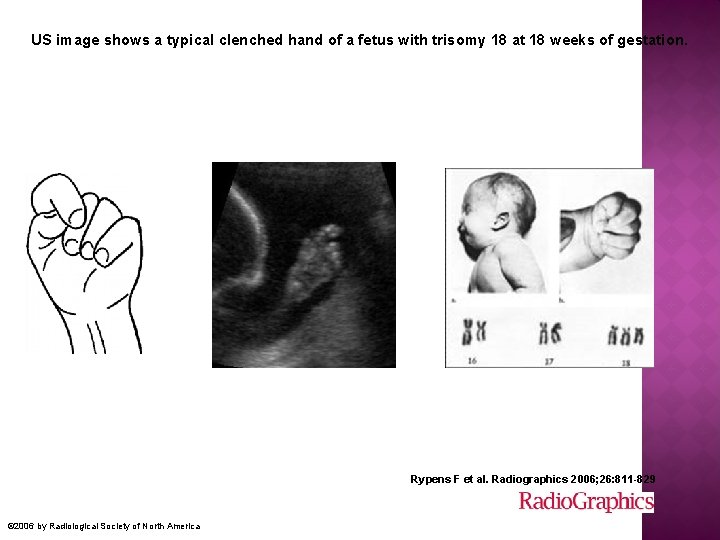 US image shows a typical clenched hand of a fetus with trisomy 18 at