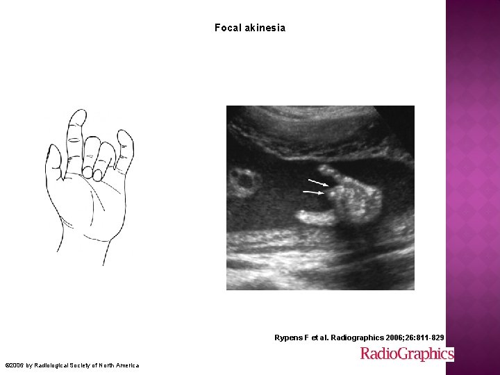 Focal akinesia Rypens F et al. Radiographics 2006; 26: 811 -829 © 2006 by