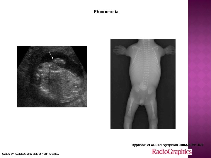  Phocomelia Rypens F et al. Radiographics 2006; 26: 811 -829 © 2006 by