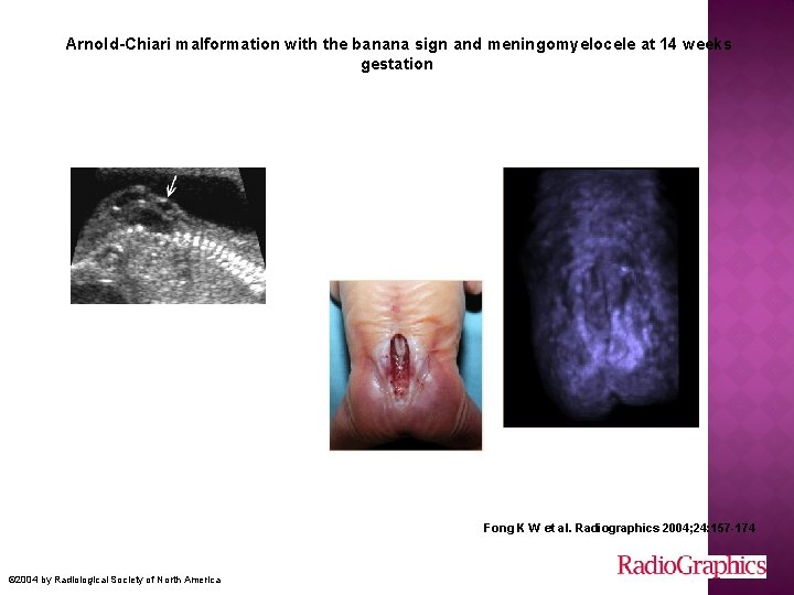  Arnold-Chiari malformation with the banana sign and meningomyelocele at 14 weeks gestation Fong