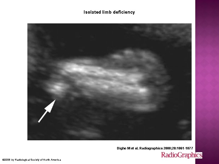 Isolated limb deficiency Dighe M et al. Radiographics 2008; 28: 1061 -1077 © 2008