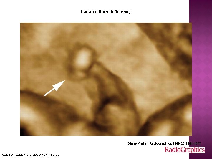 Isolated limb deficiency Dighe M et al. Radiographics 2008; 28: 1061 -1077 © 2008