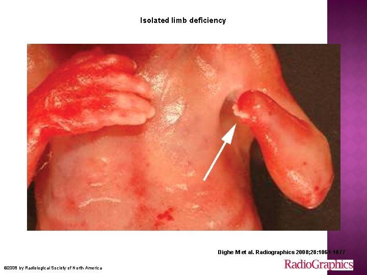 Isolated limb deficiency Dighe M et al. Radiographics 2008; 28: 1061 -1077 © 2008