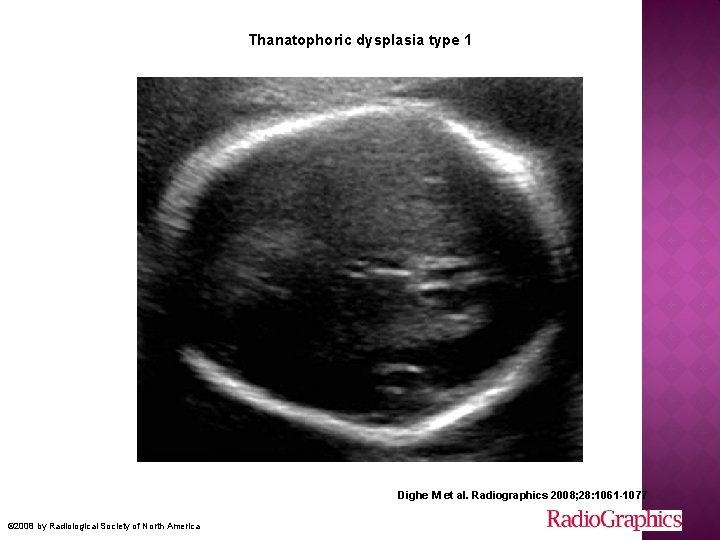 Thanatophoric dysplasia type 1 Dighe M et al. Radiographics 2008; 28: 1061 -1077 ©