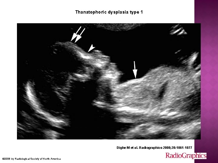 Thanatophoric dysplasia type 1 Dighe M et al. Radiographics 2008; 28: 1061 -1077 ©