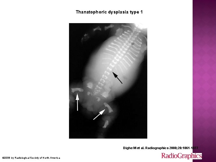  Thanatophoric dysplasia type 1 Dighe M et al. Radiographics 2008; 28: 1061 -1077