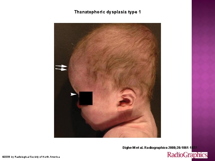 Thanatophoric dysplasia type 1 Dighe M et al. Radiographics 2008; 28: 1061 -1077 ©