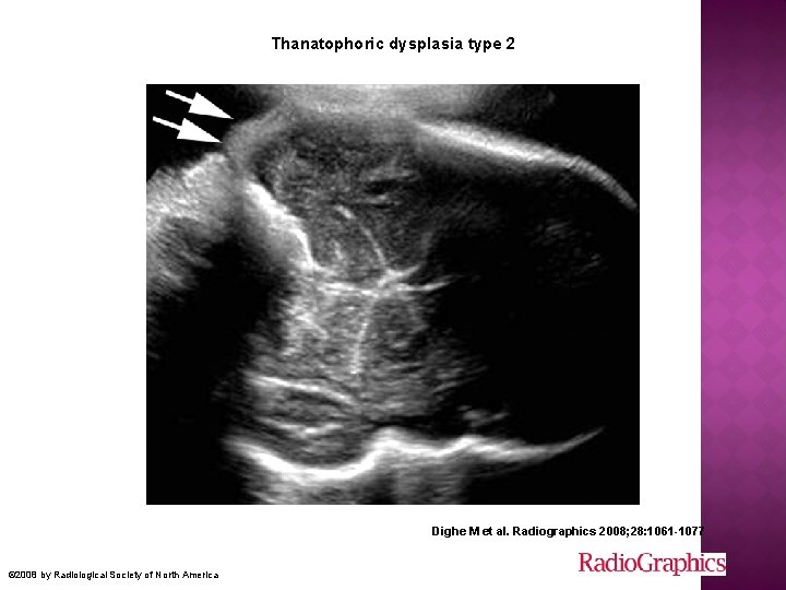 Thanatophoric dysplasia type 2 Dighe M et al. Radiographics 2008; 28: 1061 -1077 ©