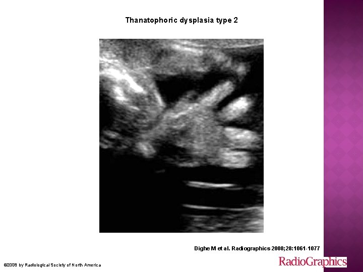 Thanatophoric dysplasia type 2 Dighe M et al. Radiographics 2008; 28: 1061 -1077 ©