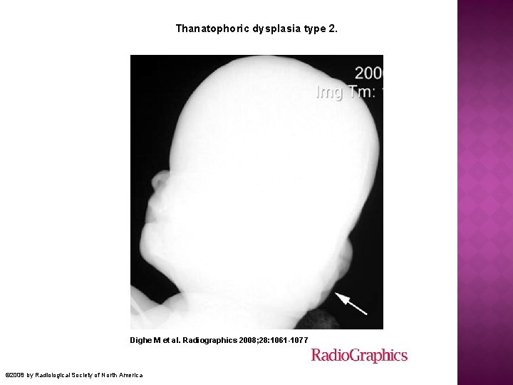 Thanatophoric dysplasia type 2. Dighe M et al. Radiographics 2008; 28: 1061 -1077 ©