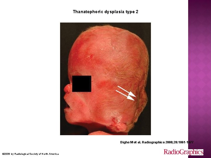 Thanatophoric dysplasia type 2 Dighe M et al. Radiographics 2008; 28: 1061 -1077 ©