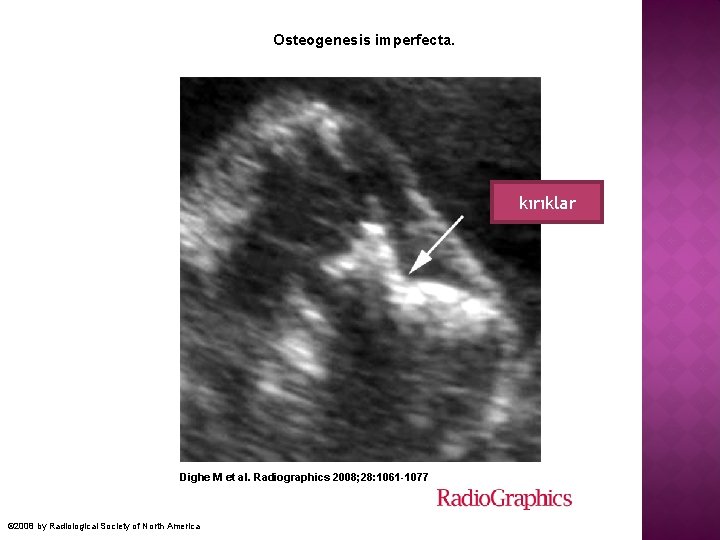  Osteogenesis imperfecta. kırıklar Dighe M et al. Radiographics 2008; 28: 1061 -1077 ©