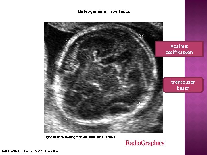  Osteogenesis imperfecta. Azalmış ossifikasyon transduser basısı Dighe M et al. Radiographics 2008; 28: