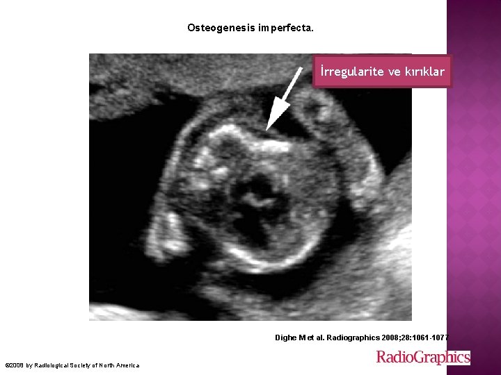 Osteogenesis imperfecta. İrregularite ve kırıklar Dighe M et al. Radiographics 2008; 28: 1061 -1077