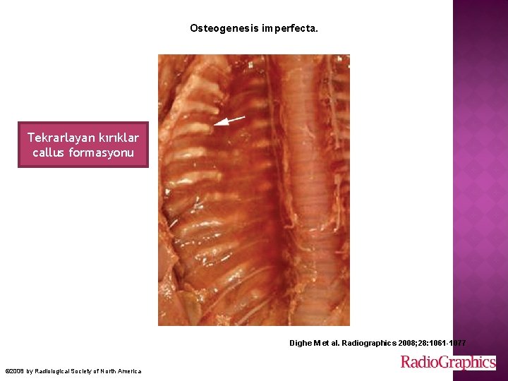 Osteogenesis imperfecta. Tekrarlayan kırıklar callus formasyonu Dighe M et al. Radiographics 2008; 28: 1061