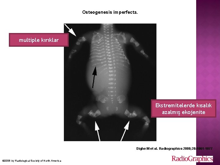 Osteogenesis imperfecta. multiple kırıklar Ekstremitelerde kısalık azalmış ekojenite Dighe M et al. Radiographics 2008;