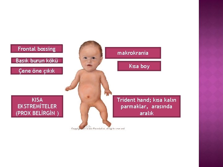 Frontal bossing Basık burun kökü Çene öne çıkık KISA EKSTREMİTELER (PROX BELİRGİN ) makrokrania