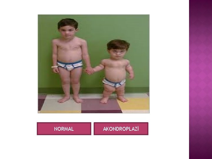 NORMAL AKONDROPLAZİ 