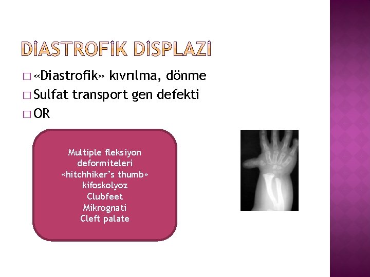 � «Diastrofik» kıvrılma, dönme � Sulfat transport gen defekti � OR Multiple fleksiyon deformiteleri