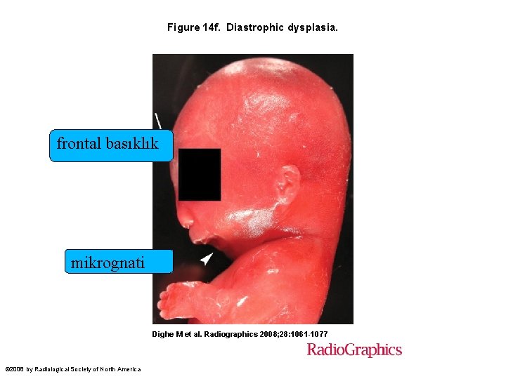 Figure 14 f. Diastrophic dysplasia. frontal basıklık mikrognati Dighe M et al. Radiographics 2008;