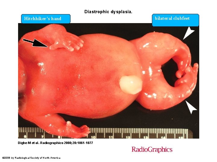 Diastrophic dysplasia. Hitchhiker’s hand Dighe M et al. Radiographics 2008; 28: 1061 -1077 ©