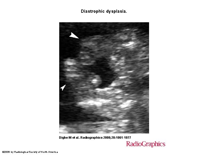 Diastrophic dysplasia. Dighe M et al. Radiographics 2008; 28: 1061 -1077 © 2008 by
