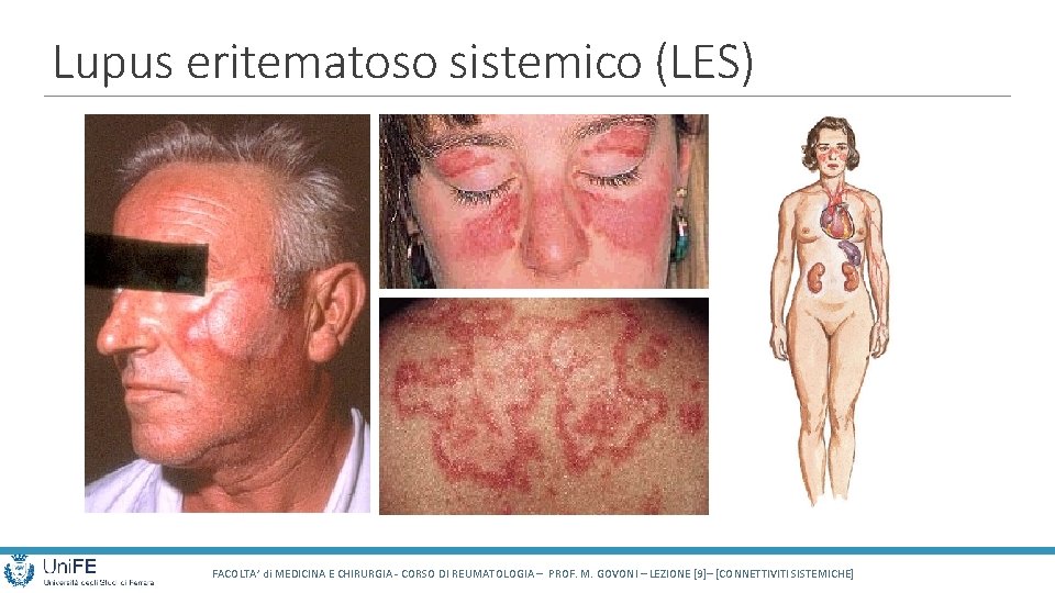 Lupus eritematoso sistemico (LES) FACOLTA’ di MEDICINA E CHIRURGIA - CORSO DI REUMATOLOGIA –