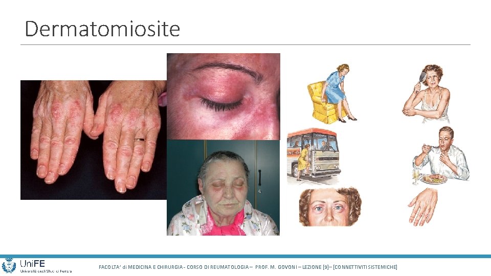 Dermatomiosite FACOLTA’ di MEDICINA E CHIRURGIA - CORSO DI REUMATOLOGIA – PROF. M. GOVONI
