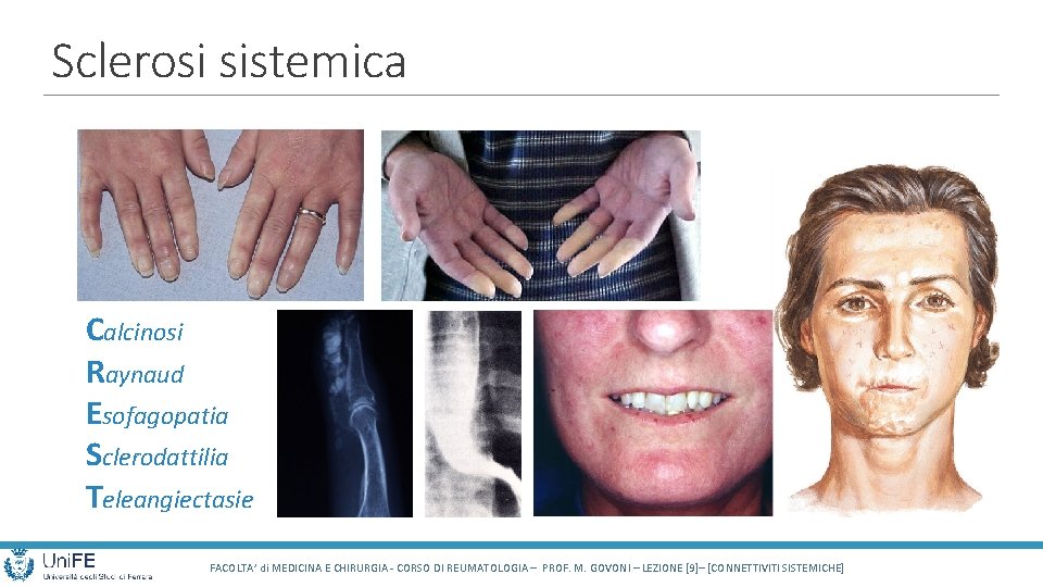 Sclerosi sistemica Calcinosi Raynaud Esofagopatia Sclerodattilia Teleangiectasie FACOLTA’ di MEDICINA E CHIRURGIA - CORSO
