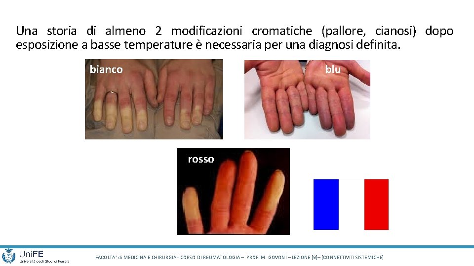 Una storia di almeno 2 modificazioni cromatiche (pallore, cianosi) dopo esposizione a basse temperature