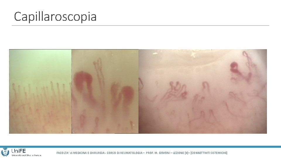 Capillaroscopia FACOLTA’ di MEDICINA E CHIRURGIA - CORSO DI REUMATOLOGIA – PROF. M. GOVONI