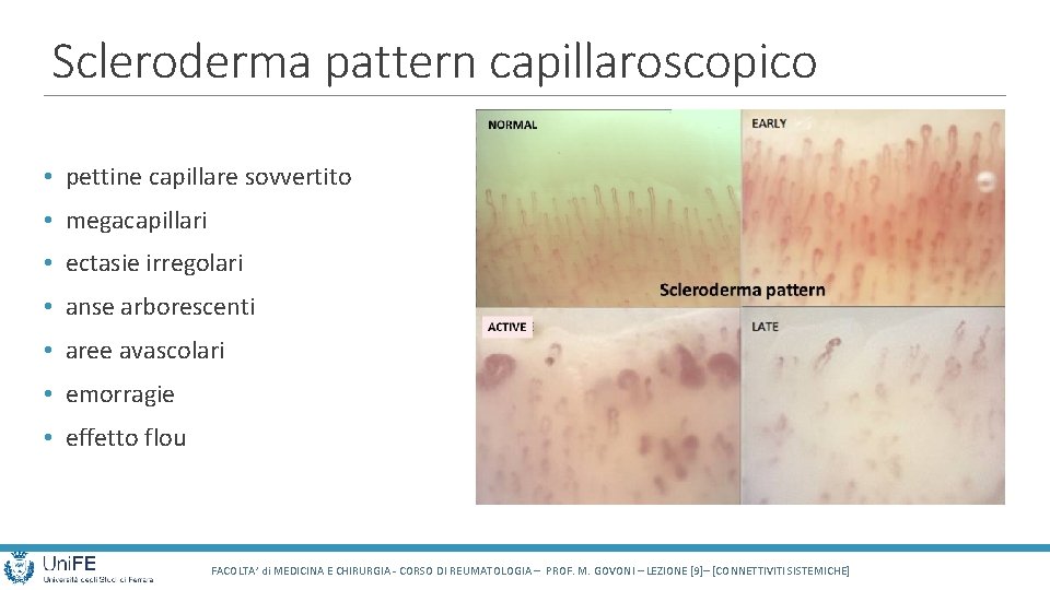 Scleroderma pattern capillaroscopico • pettine capillare sovvertito • megacapillari • ectasie irregolari • anse