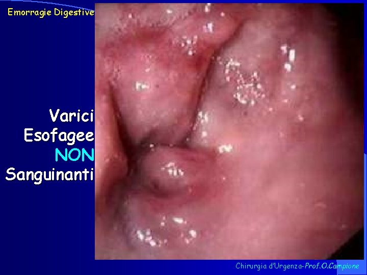 Emorragie Digestive Varici Esofagee NON Sanguinanti Chirurgia d’Urgenza-Prof. O. Campione 