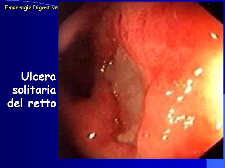 Emorragie Digestive Ulcera solitaria del retto 