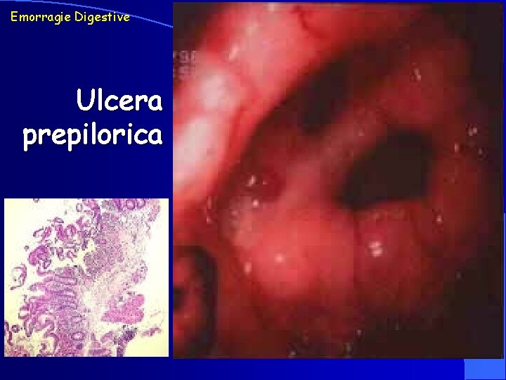 Emorragie Digestive Ulcera prepilorica 