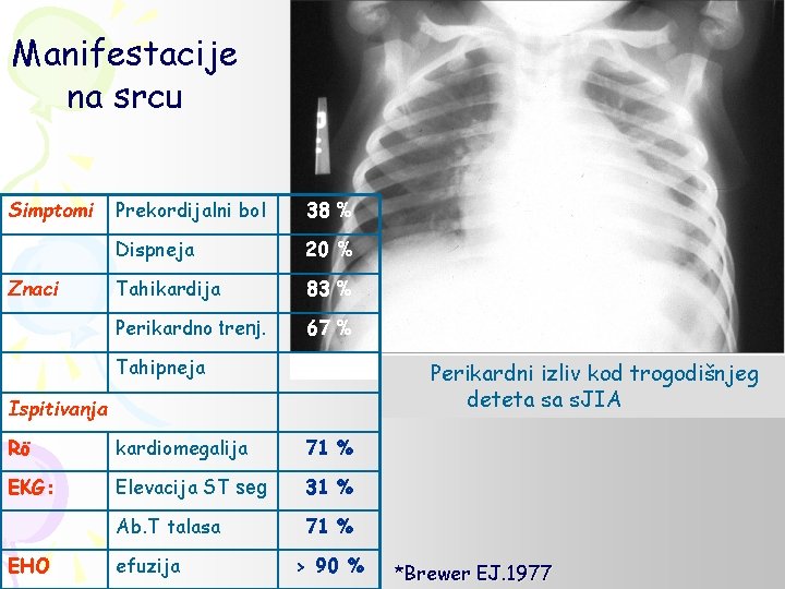 Manifestacije na srcu Simptomi Prekordijalni bol 38 % Dispneja 20 % Tahikardija 83 %
