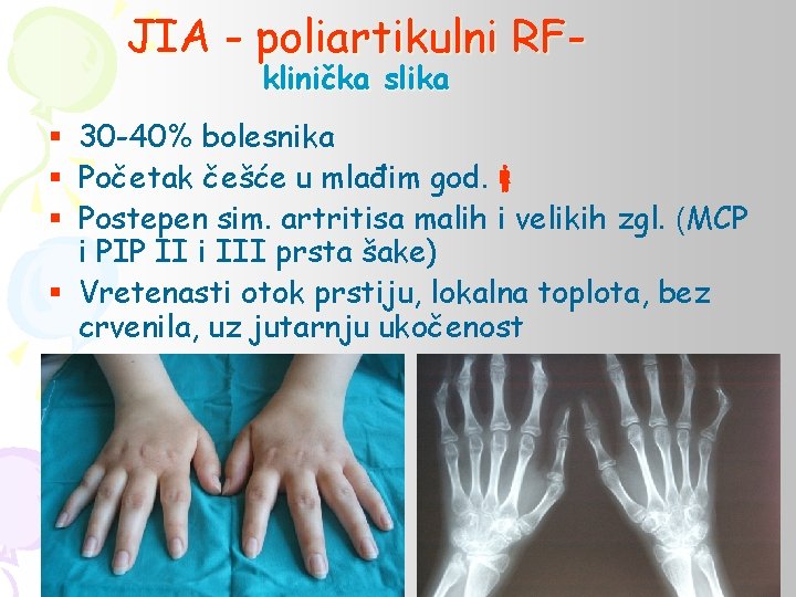 JIA - poliartikulni RFklinička slika § 30 -40% bolesnika § Početak češće u mlađim