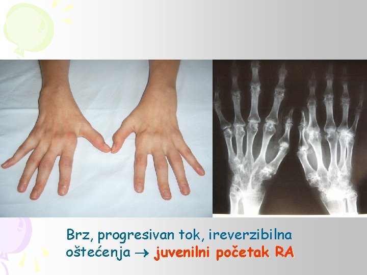 Brz, progresivan tok, ireverzibilna oštećenja juvenilni početak RA 