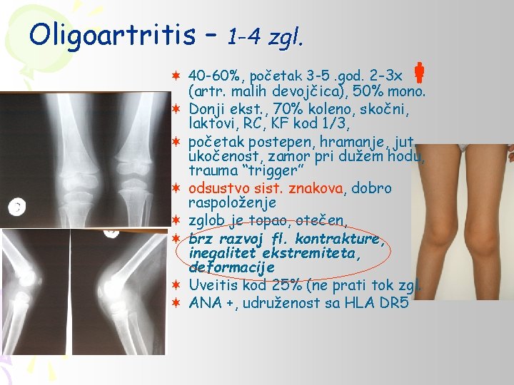 Oligoartritis – 1 -4 zgl. ¬ 40 -60%, početak 3 -5. god. 2 -3