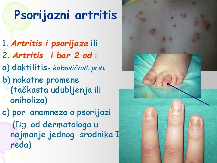 Psorijazni artritis 1. Artritis i psorijaza ili 2. Artritis i bar 2 od :