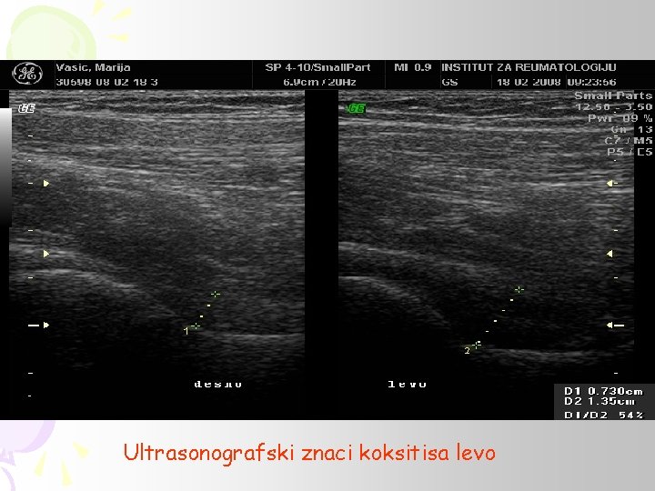 Ultrasonografski znaci koksitisa levo 