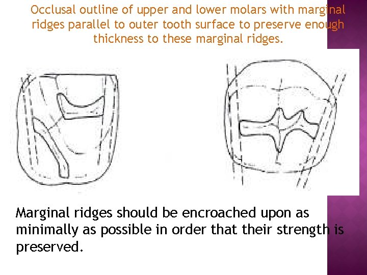 Occlusal outline of upper and lower molars with marginal ridges parallel to outer tooth