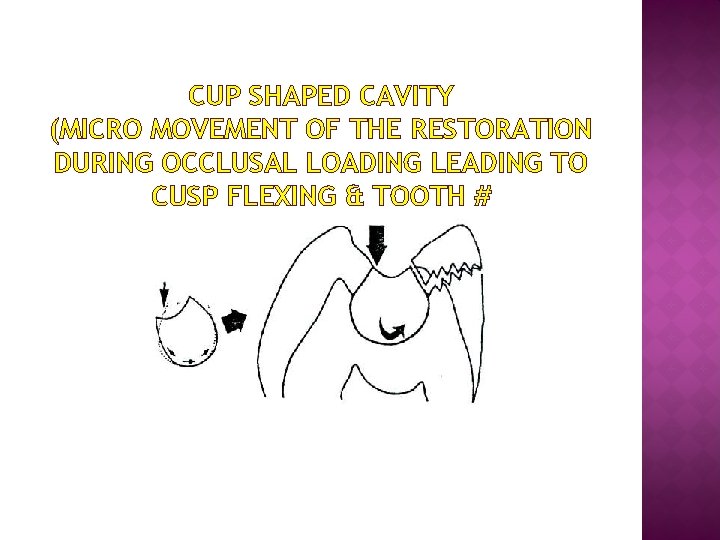 CUP SHAPED CAVITY (MICRO MOVEMENT OF THE RESTORATION DURING OCCLUSAL LOADING LEADING TO CUSP