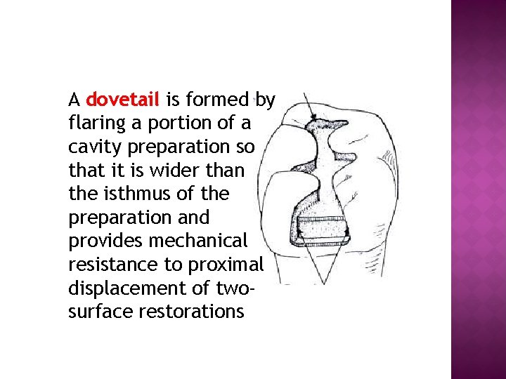 A dovetail is formed by flaring a portion of a cavity preparation so that