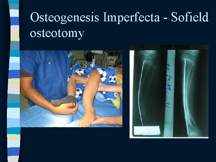 Osteogenesis Imperfecta - Sofield osteotomy Osteogenesis Imperfecta - Sofield osteotomy