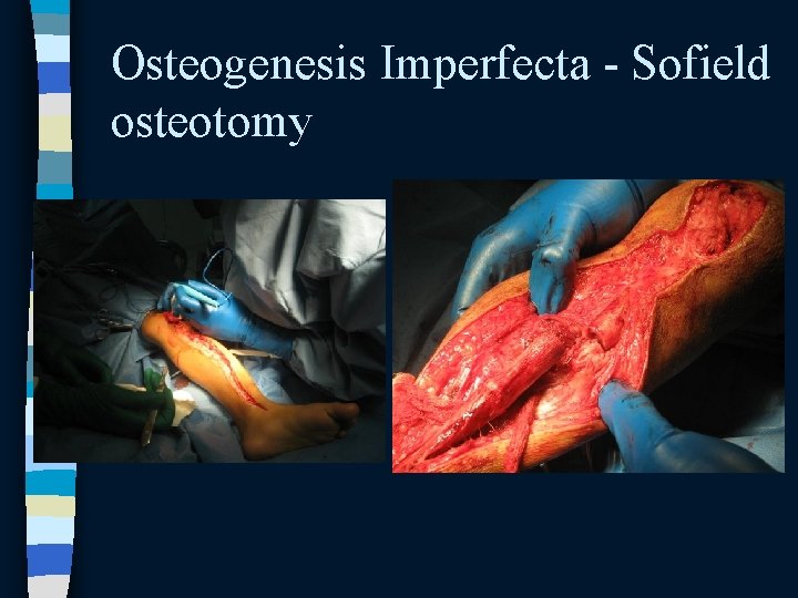 Osteogenesis Imperfecta - Sofield osteotomy Osteogenesis Imperfecta - Sofield osteotomy